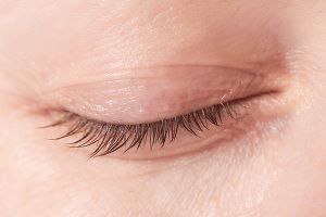 Glaucoma