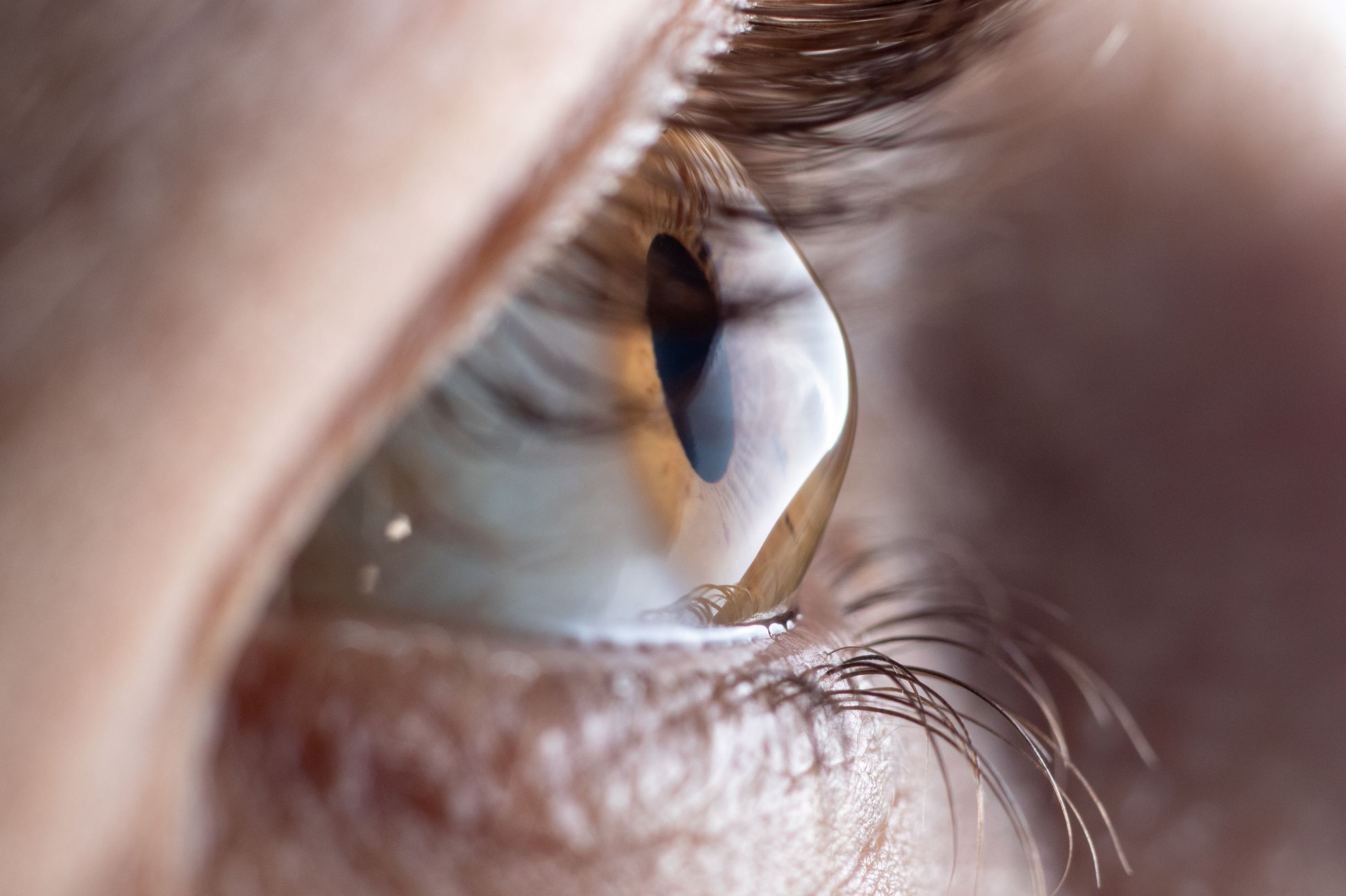 A person with keratconus, a disease of the cornea